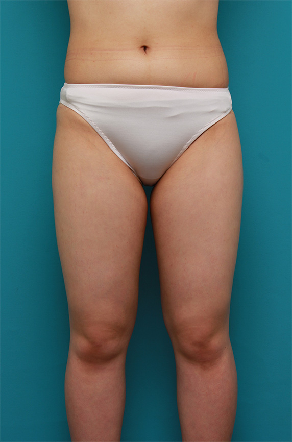症例写真,太もも全体~お尻を細くしたイタリアン・メソシェイプ（イタリアンメソセラピー）・脂肪溶解注射の症例写真,After,ba_meso88_b.jpg