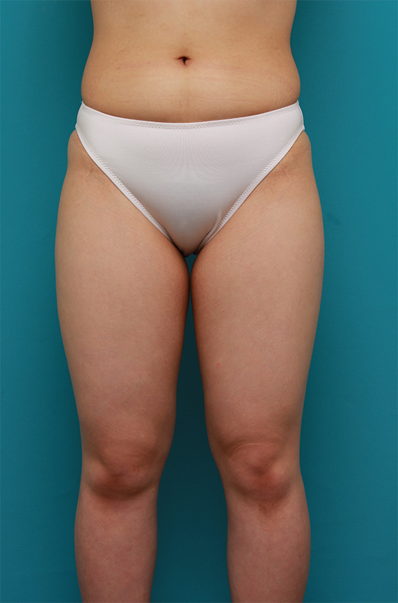 太もも全体~お尻を細くしたイタリアン・メソシェイプ（イタリアンメソセラピー）・脂肪溶解注射の症例写真,Before,ba_meso88_b.jpg
