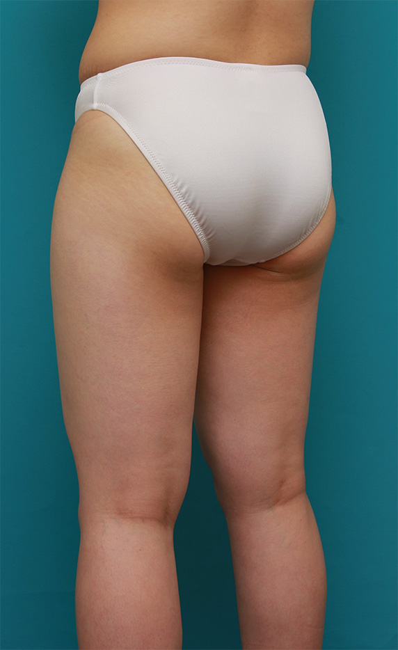 症例写真,太もも全体~お尻を細くしたイタリアン・メソシェイプ（イタリアンメソセラピー）・脂肪溶解注射の症例写真,Before,ba_meso91_b.jpg