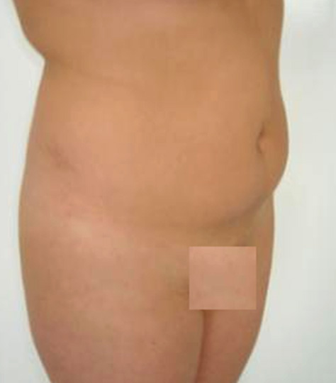 ミケランジェロ(TM) 腹部全体の脂肪を減らした患者様の症例,Before,ba_michelangelo01_b.jpg