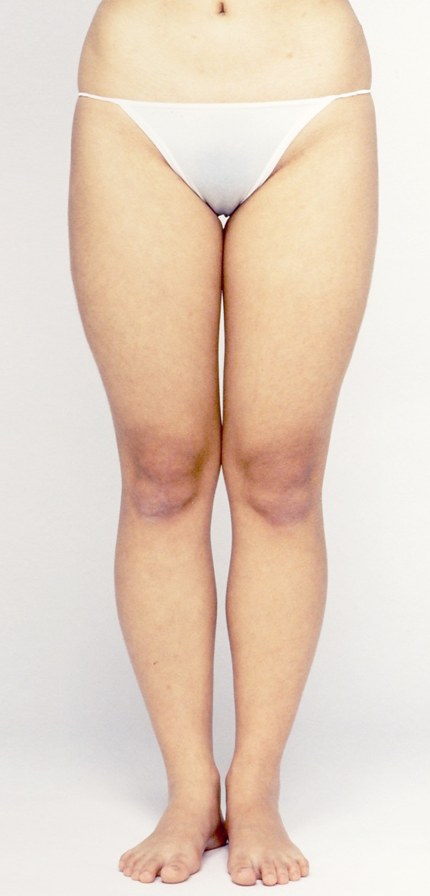 症例写真,太もも全体（前面、後面、内側、外側、膝上）とふくらはぎの脂肪吸引をした30代女性の症例写真,Before,ba_shibokyuin34_b.jpg