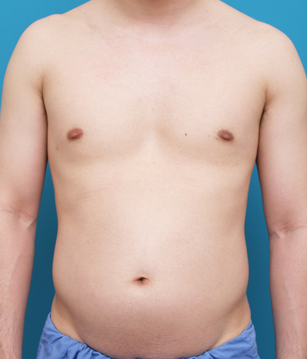 症例写真,お腹回りを全体的に脂肪吸引し、ぽっこりお腹を引っ込めた30代男性の症例写真,Before,ba_shibokyuin40_b.jpg
