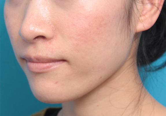 30代女性にボツリヌストキシン注射（エラ、プチ小顔術）を行い、頬が痩けたり、顔が弛むことなく小顔にした症例写真の術前術後画像,After（2ヶ月後）,ba_botox13_a01.jpg