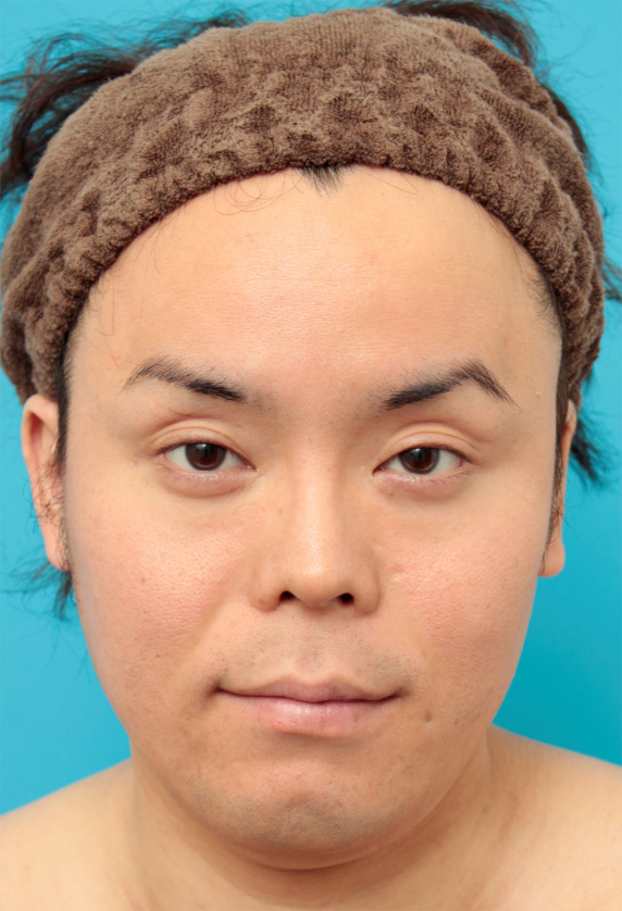 ボツリヌストキシン注射（エラ、プチ小顔術）で小顔にした男性の症例写真,After（1ヶ月後）,ba_botox16_a01.jpg