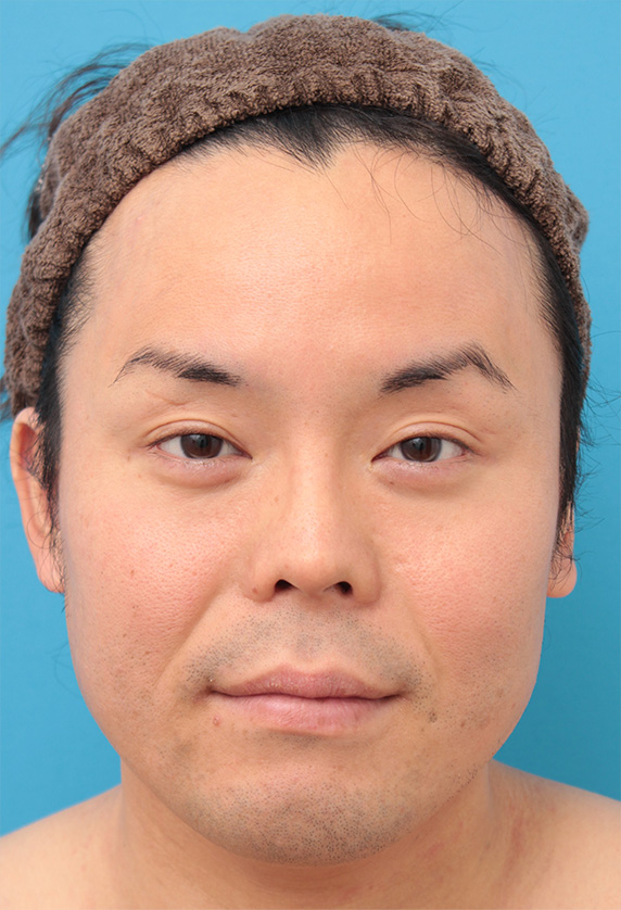 ボツリヌストキシン注射（エラ、プチ小顔術）,ボツリヌストキシン注射（エラ、プチ小顔術）で小顔にした男性の症例写真,Before,ba_botox16_b.jpg