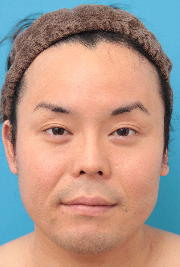 症例写真,ボツリヌストキシン注射（エラ、プチ小顔術）で小顔にした男性の症例写真,治療前,mainpic_botox03a.jpg