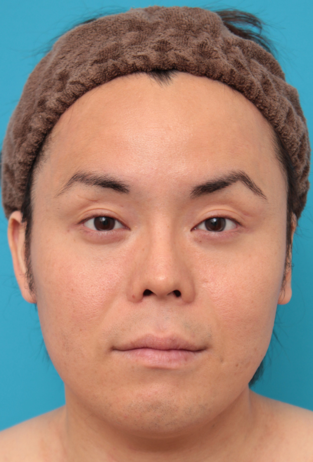 症例写真,ボツリヌストキシン注射（エラ、プチ小顔術）で小顔にした男性の症例写真,6ヶ月後,mainpic_botox03d.jpg