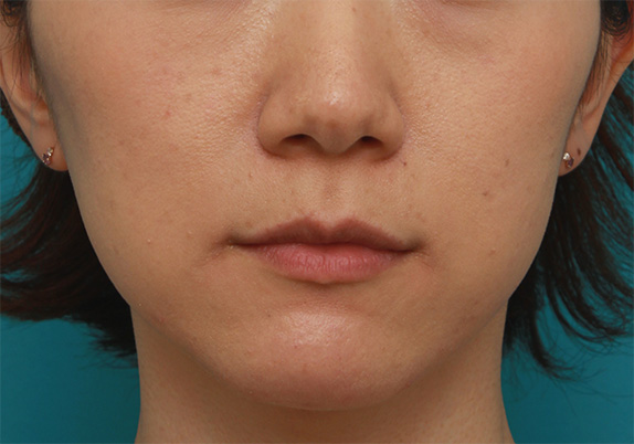 ボツリヌストキシン注射（エラ、プチ小顔術）で、顎関節症、歯軋りが改善し、小顔にもなった症例写真の術前術後画像,Before,ba_botox17_b.jpg