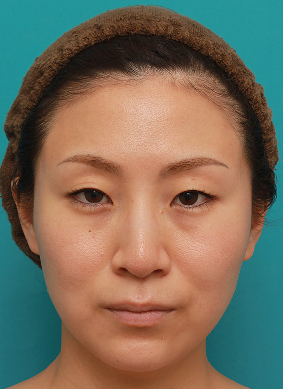 ボツリヌストキシン注射（エラ、プチ小顔術）でほっそりした小顔になった女性の症例写真の術前術後画像,After（4ヶ月後）,ba_botox19_a01.jpg