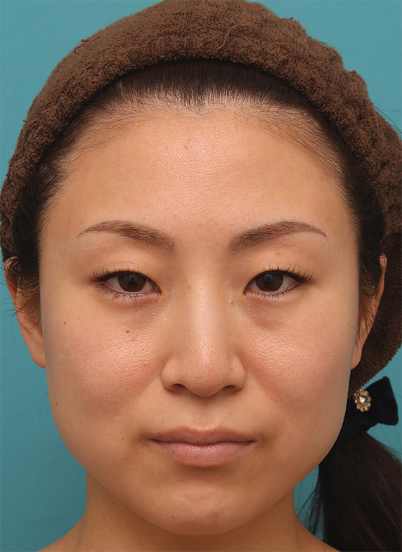ボツリヌストキシン注射（エラ、プチ小顔術）でほっそりした小顔になった女性の症例写真の術前術後画像,Before,ba_botox19_b.jpg