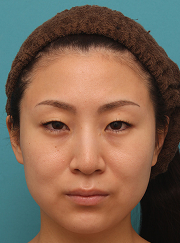 症例写真,ボツリヌストキシン注射（エラ、プチ小顔術）でほっそりした小顔になった女性の症例写真の術前術後画像,1週間後,mainpic_botox04b.jpg