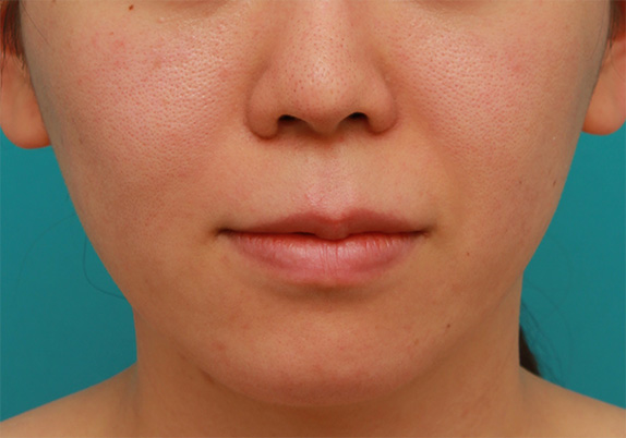 症例写真,バッカルファット除去手術で頬の膨らみとたるみを改善させた20代女性の症例 術前術後画像,After（6ヶ月後）,ba_buccalfat05_b.jpg
