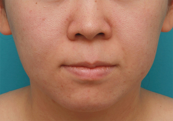 症例写真,バッカルファット除去手術で頬の膨らみとたるみを改善させた20代女性の症例 術前術後画像,Before,ba_buccalfat05_b.jpg