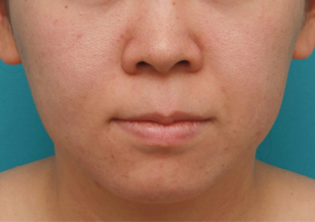 症例写真,バッカルファット除去手術で頬の膨らみとたるみを改善させた20代女性の症例 術前術後画像,手術前,mainpic_buccalfat03a.jpg