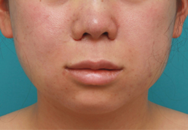 症例写真,バッカルファット除去手術で頬の膨らみとたるみを改善させた20代女性の術前術後画像,手術直後,mainpic_buccalfat03b.jpg