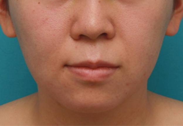 症例写真,バッカルファット除去手術で頬の膨らみとたるみを改善させた20代女性の術前術後画像,1週間後,mainpic_buccalfat03c.jpg