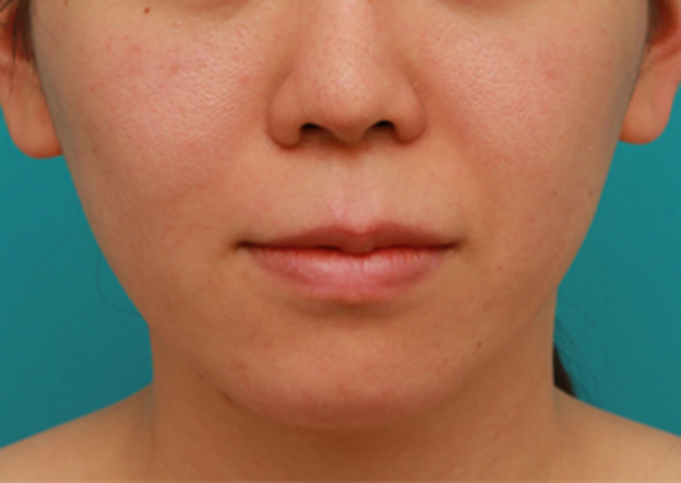 症例写真,バッカルファット除去手術で頬の膨らみとたるみを改善させた20代女性の症例 術前術後画像,6ヶ月後,mainpic_buccalfat03d.jpg