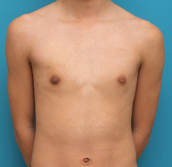 症例写真,女性化乳房修正手術の症例写真,After,ba_gynecomastia_pic06_b.jpg