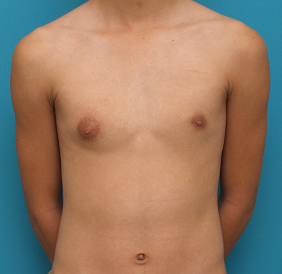女性化乳房修正手術の症例写真,Before,ba_gynecomastia_pic06_b.jpg