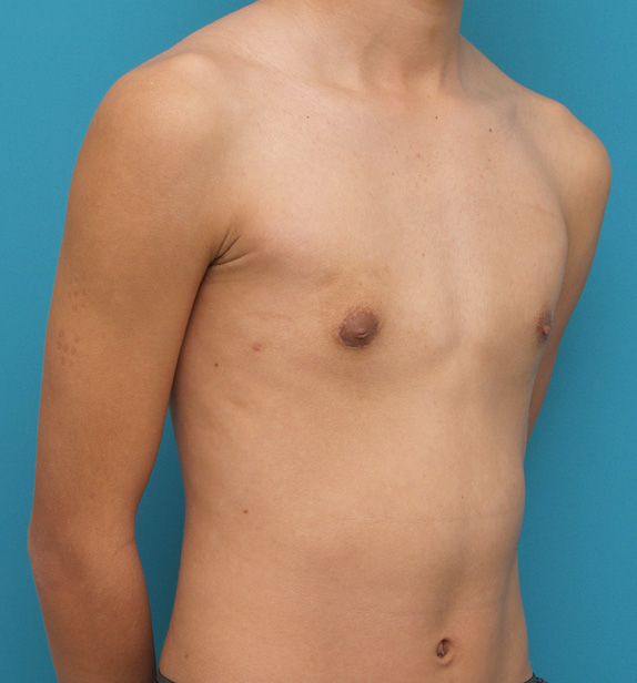 症例写真,女性化乳房修正手術の症例写真,After,ba_gynecomastia_pic07_b.jpg