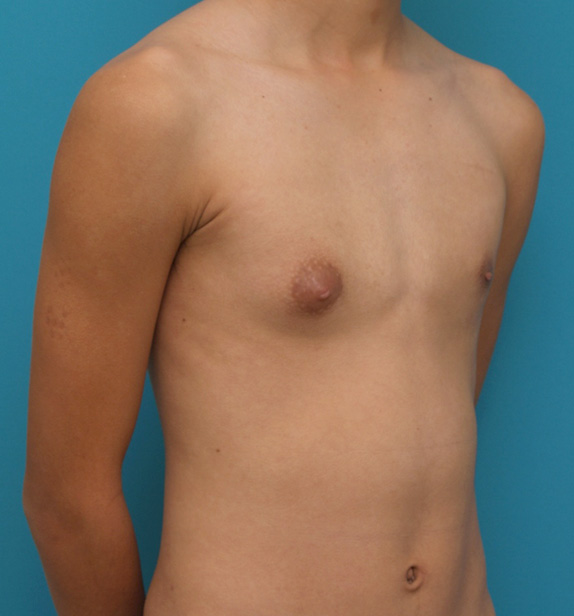 症例写真,女性化乳房修正手術の症例写真,Before,ba_gynecomastia_pic07_b.jpg