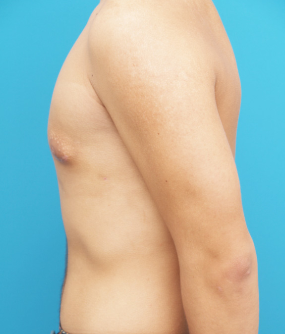 症例写真,女性化乳房除去の症例写真 脂肪吸引+乳腺除去,After,ba_gynecomastia_pic04_b.jpg
