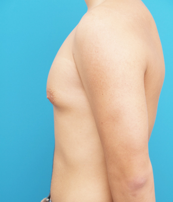 症例写真,女性化乳房除去の症例写真 脂肪吸引+乳腺除去,Before,ba_gynecomastia_pic04_b.jpg