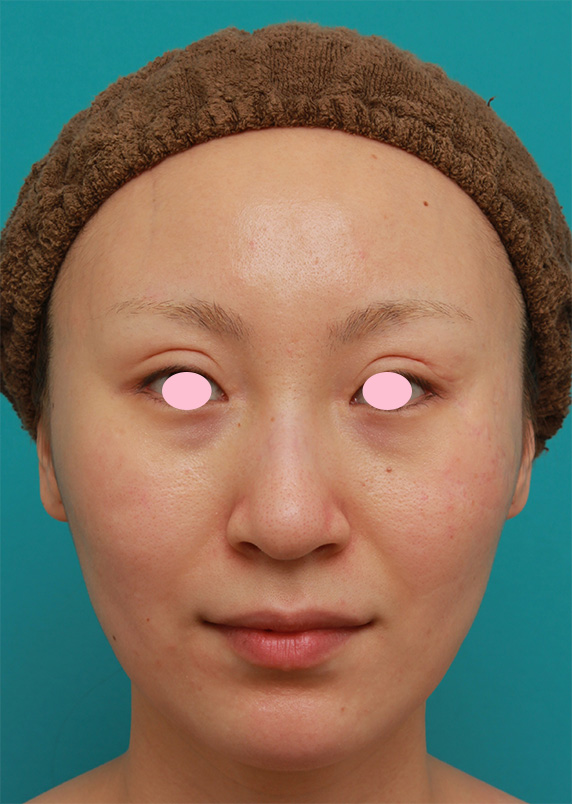 症例写真,20代女性にバッカルファット切除を行い、小顔効果、頬たるみ老化予防効果を出した症例写真の術前術後画像,After（6ヶ月後）,ba_buccalfat06_b.jpg