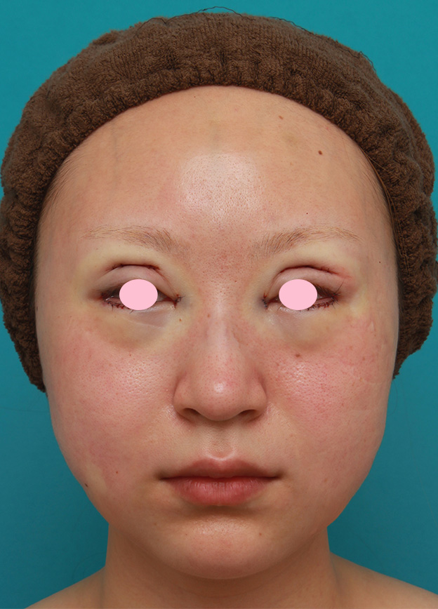 症例写真,20代女性にバッカルファット切除を行い、小顔効果、頬たるみ老化予防効果を出した症例写真の術前術後画像,手術直後,mainpic_buccalfat04b.jpg