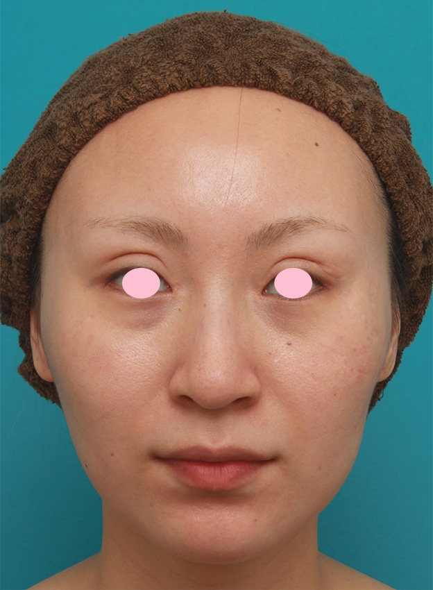 症例写真,20代女性にバッカルファット切除を行い、小顔効果、頬たるみ老化予防効果を出した症例写真の術前術後画像,1週間後,mainpic_buccalfat04c.jpg