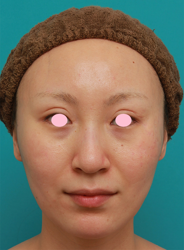 症例写真,20代女性にバッカルファット切除を行い、小顔効果、頬たるみ老化予防効果を出した症例写真の術前術後画像,6ヶ月後,mainpic_buccalfat04d.jpg