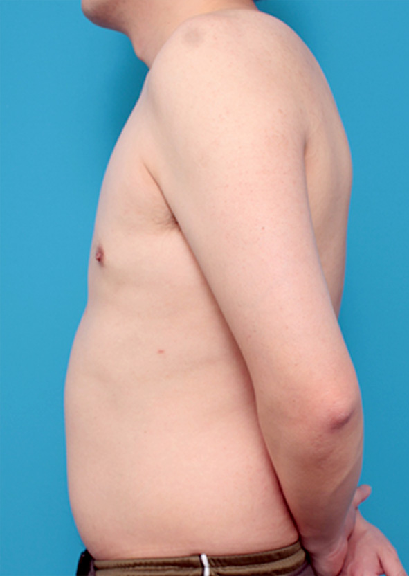 症例写真,女性化乳房の症例写真,After,ba_gynecomastia_pic10_b.jpg