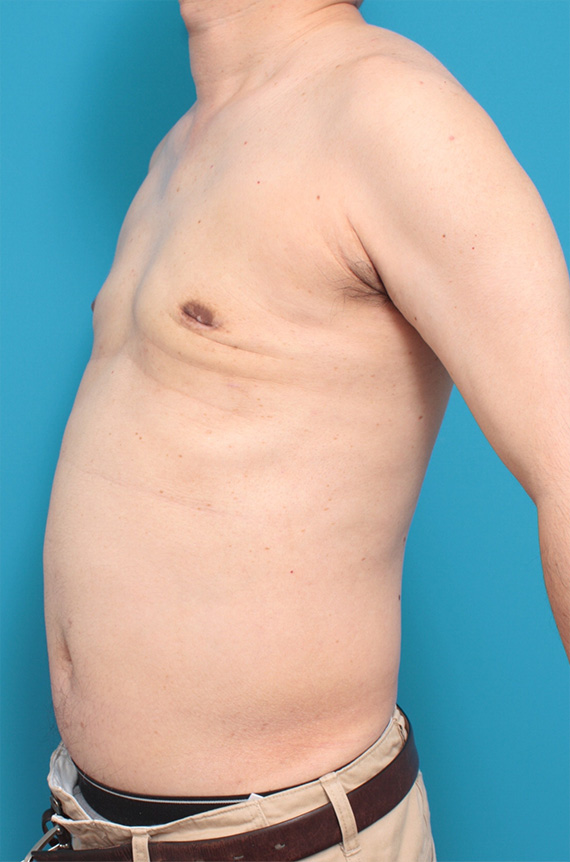 症例写真,巨大な女性化乳房の手術症例写真,After,ba_gynecomastia_pic12_b.jpg