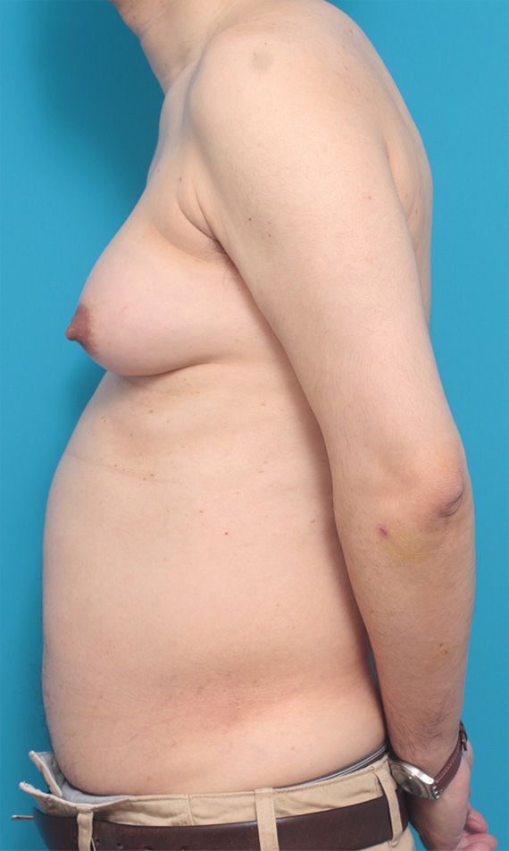 症例写真,巨大な女性化乳房の手術症例写真,Before,ba_gynecomastia_pic13_b.jpg