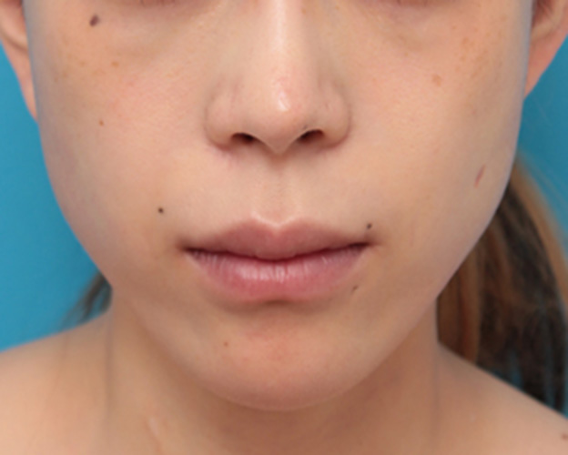 症例写真,バッカルファットを除去し頬をスッキリさせた20代女性の症例写真の術前術後画像,1週間後,mainpic_buccalfat05c.jpg