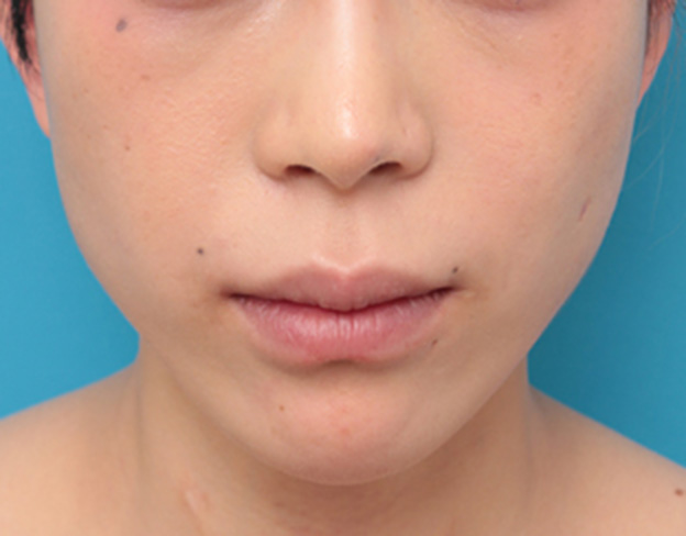 症例写真,バッカルファットを除去し頬をスッキリさせた20代女性の症例写真の術前術後画像,6ヶ月後,mainpic_buccalfat05d.jpg
