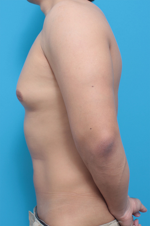 症例写真,ボディービルダーが筋力増強剤の副作用でなったと思われる女性化乳房の手術の症例写真,Before,ba_gynecomastia_pic18_b.jpg