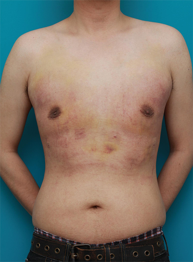 症例写真,乳腺除去と脂肪吸引を併用した女性化乳房の手術症例写真,3日後,mainpic_gynecomastia01c.jpg