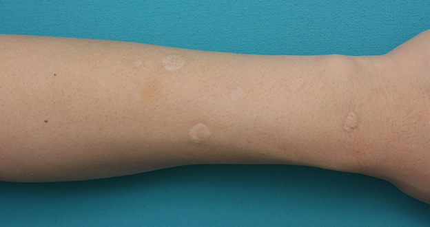 傷跡修正の症例写真 タバコの火傷跡が目立つ皮膚を切り縫い合わせ修正,Before,ba_keisei15_b.jpg
