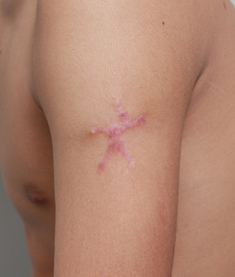 症例写真,刺青の切除縫縮手術の症例写真,2回目手術後（1ヶ月）,mainpic_irezumi04e.jpg