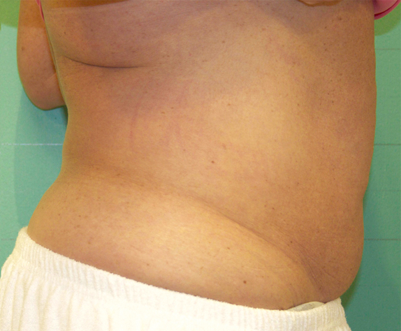 症例写真,EXILIS ELITE(TM)/エクシリス エリート(ボディ)の症例写真1,After,ba_exilis_elite01_b.jpg