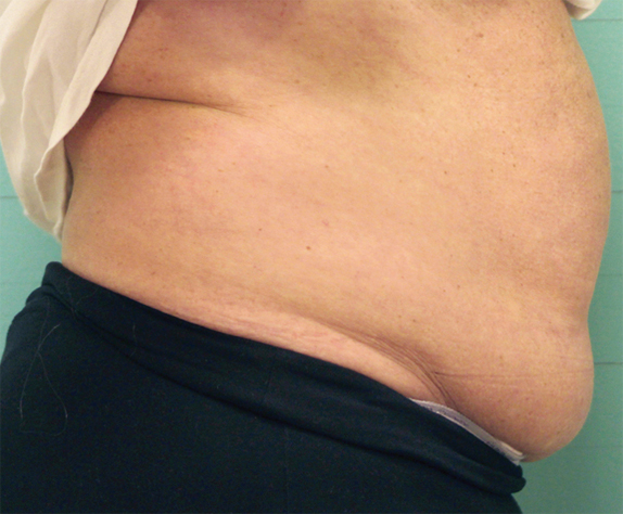 症例写真,EXILIS ELITE(TM)/エクシリス エリート(ボディ)の症例写真1,Before,ba_exilis_elite01_b.jpg