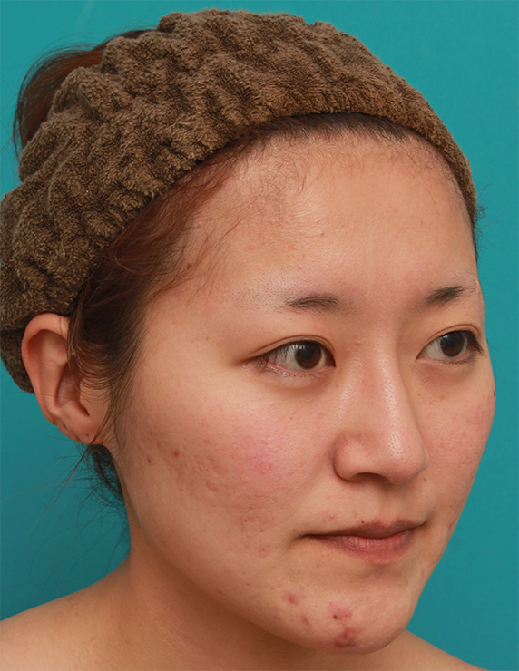 症例写真,長期持続型ヒアルロン酸注射で、眉間から自然に鼻筋を通した症例写真の術前術後画像,After（1ヶ月後）,ba_ryubichusha53_b.jpg