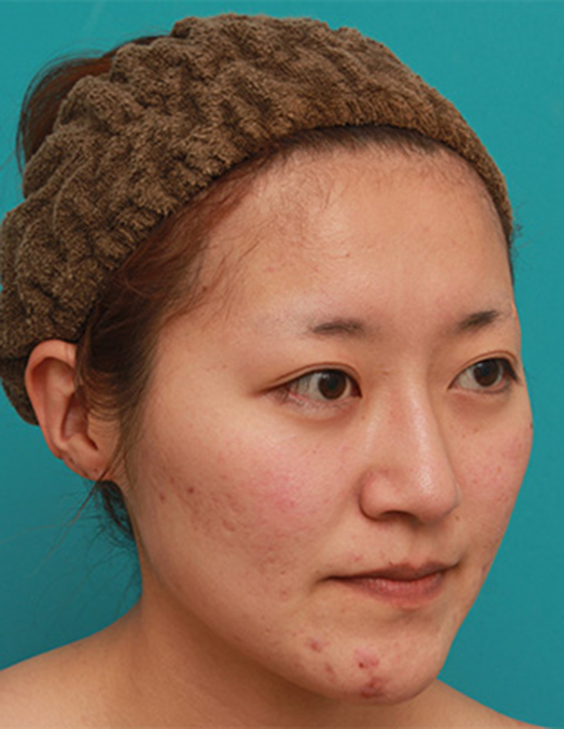 症例写真,長期持続型ヒアルロン酸注射で、眉間から自然に鼻筋を通した症例写真の術前術後画像,1ヶ月後,mainpic_ryubichusha06i.jpg