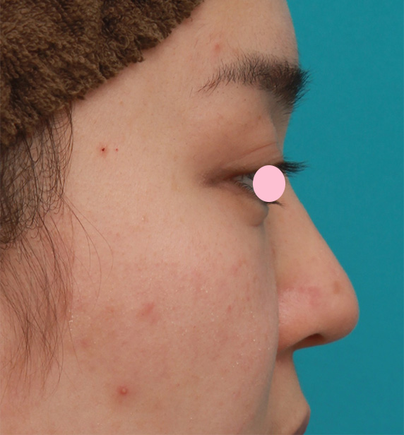 耳介軟骨移植（鼻先を出す）,団子鼻に対して鼻尖縮小はせず耳介軟骨移植のみを行った症例写真の術前術後画像,After（4ヶ月後）,ba_jikai47_b.jpg