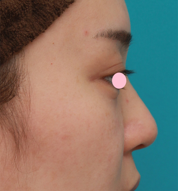 耳介軟骨移植（鼻先を出す）,団子鼻に対して鼻尖縮小はせず耳介軟骨移植のみを行った症例写真の術前術後画像,Before,ba_jikai47_b.jpg