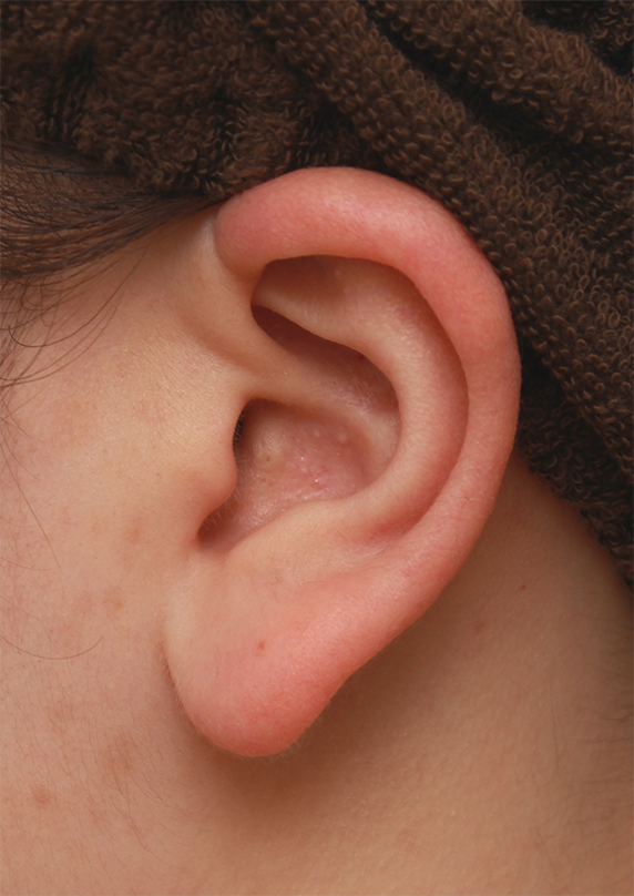 症例写真,団子鼻に対して鼻尖縮小はせず耳介軟骨移植のみを行った症例写真の術前術後画像,Before,ba_jikai48_b.jpg