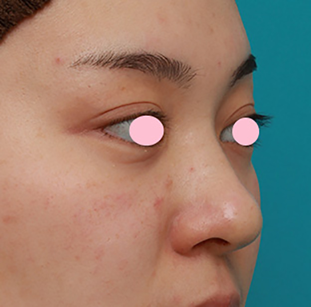 症例写真,団子鼻に対して鼻尖縮小はせず耳介軟骨移植のみを行った症例写真の術前術後画像,手術直後,mainpic_jikai08f.jpg