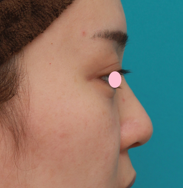 耳介軟骨移植（鼻先を出す）,団子鼻に対して鼻尖縮小はせず耳介軟骨移植のみを行った症例写真の術前術後画像,手術前,mainpic_jikai08i.jpg