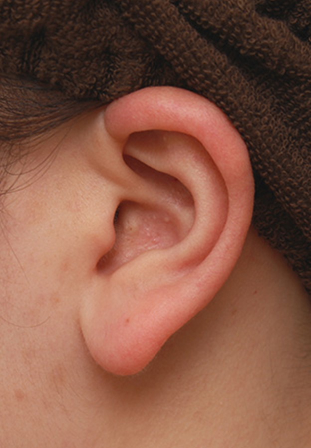 耳介軟骨移植（鼻先を出す）,団子鼻に対して鼻尖縮小はせず耳介軟骨移植のみを行った症例写真の術前術後画像,手術前,mainpic_jikai08m.jpg